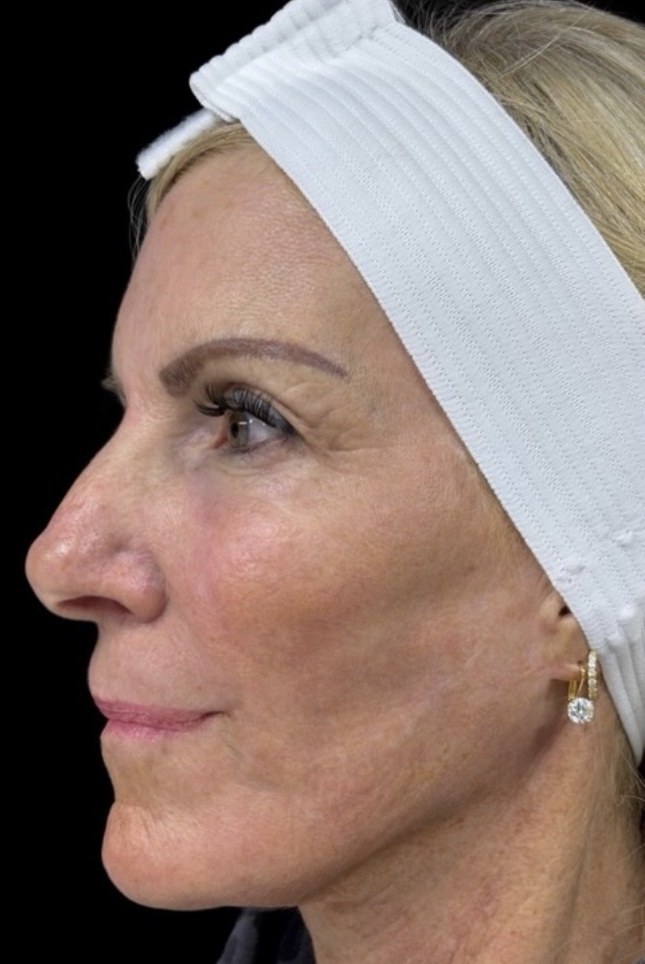 Profile view after full facial rejuvenation at ICON, smoother and lifted