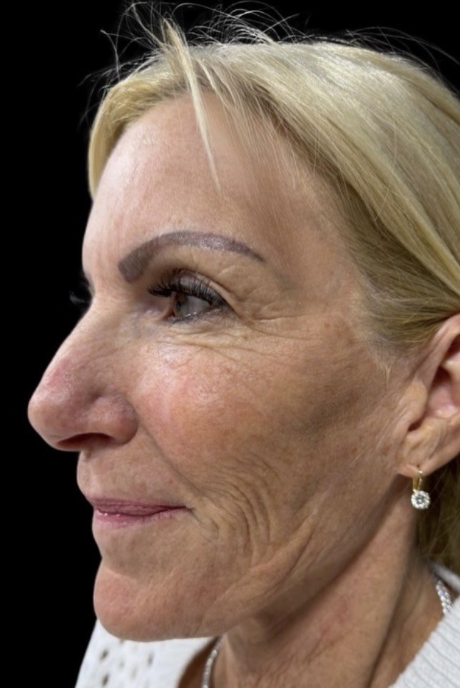 Profile view before full facial rejuvenation at ICON