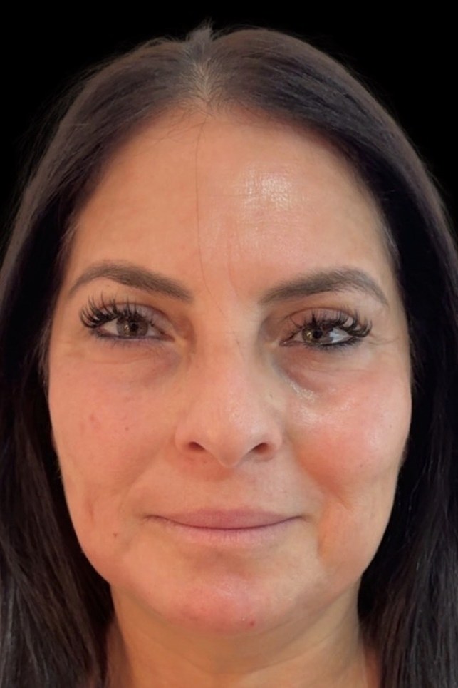 Front view after full facial rejuvenation at ICON, refreshed and balanced