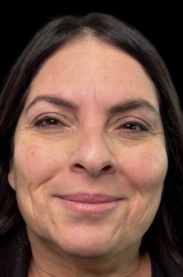 Front view before full facial rejuvenation at ICON