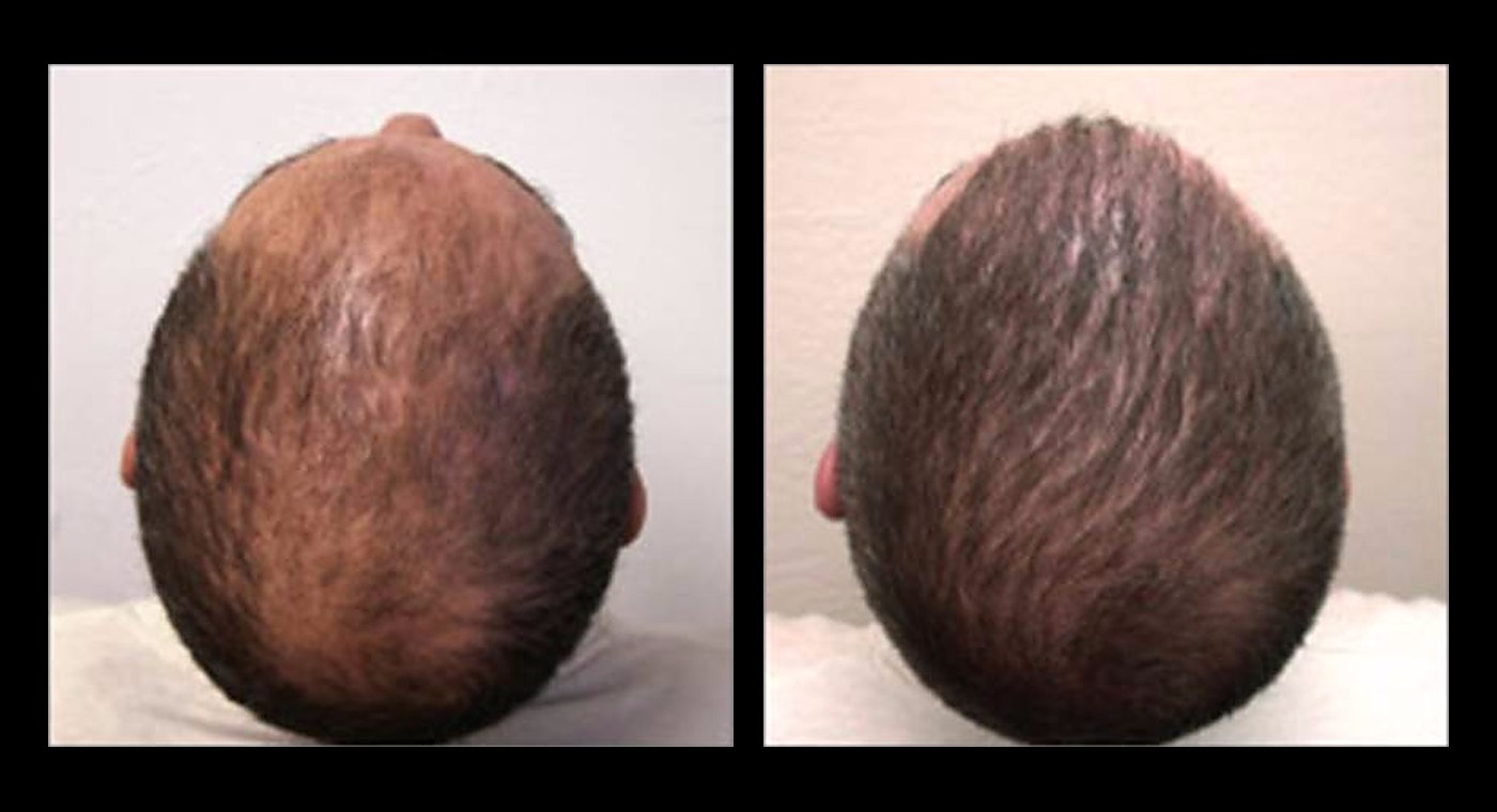 Representative NeoGraft result, crown from above, before and after