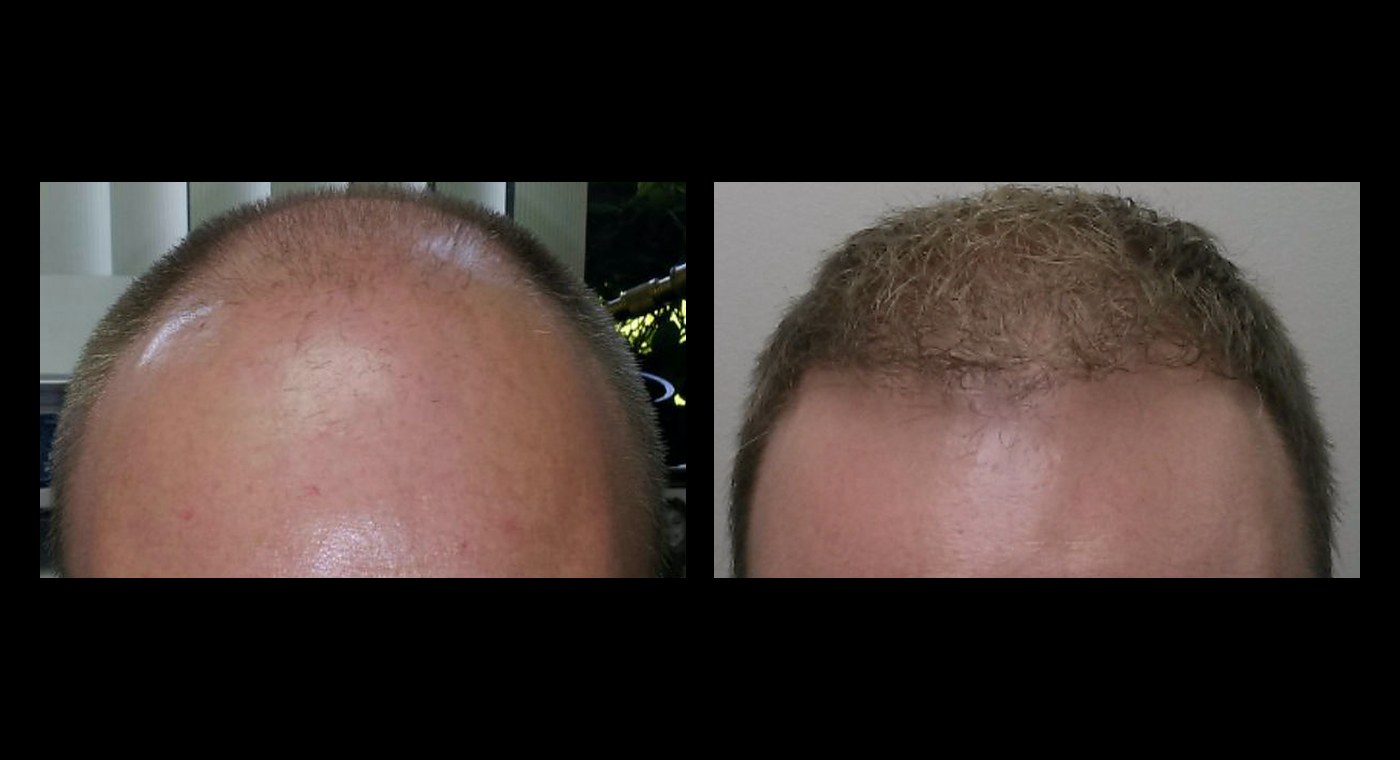 Representative NeoGraft result, frontal view at 11 months, before and after