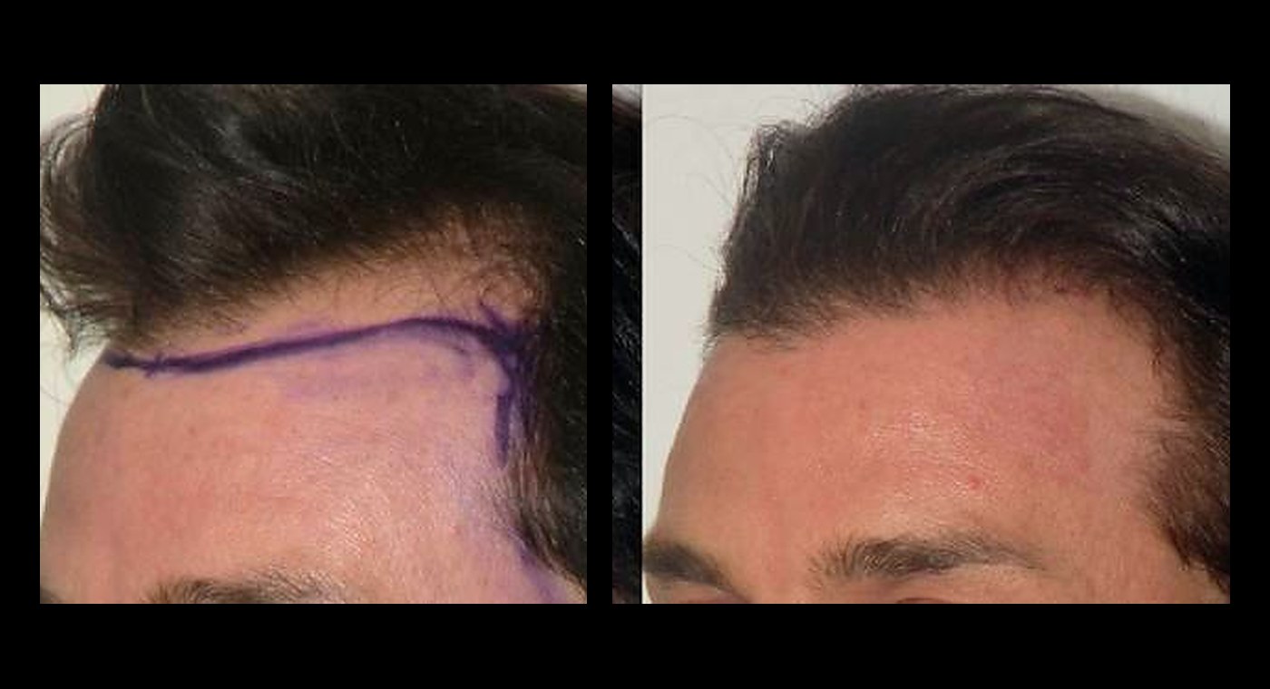 Representative NeoGraft result showing hairline design markings and final outcome