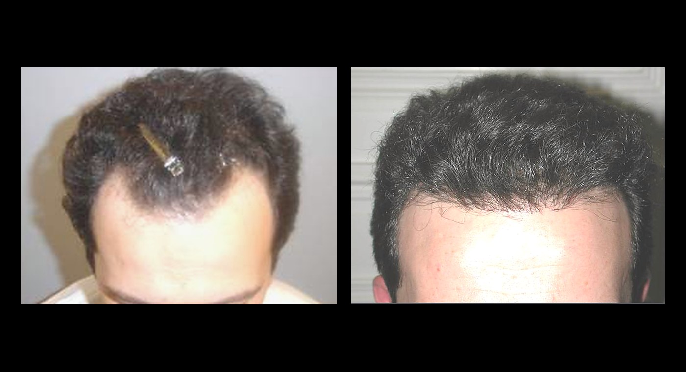 Representative NeoGraft result, frontal hairline, before and after