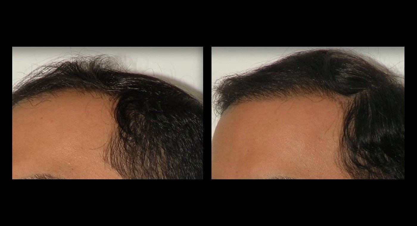 Representative NeoGraft result, side hairline, before and after