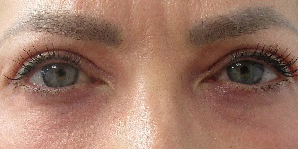 Under-eye area after Undereye Erase treatment at ICON, showing smoother, brighter skin