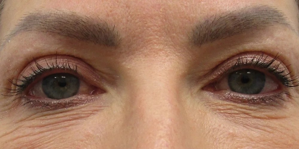 Under-eye area before Undereye Erase treatment at ICON, showing crepiness and fine lines