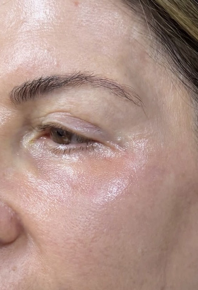 Close-up of under-eye area after Undereye Erase at ICON, smoother and brighter