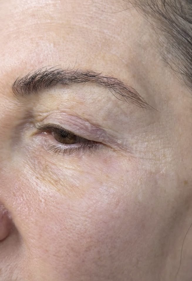 Close-up of under-eye area before Undereye Erase at ICON, showing texture and discoloration